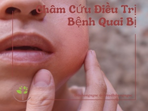 Châm cứu điều trị bệnh quai bị