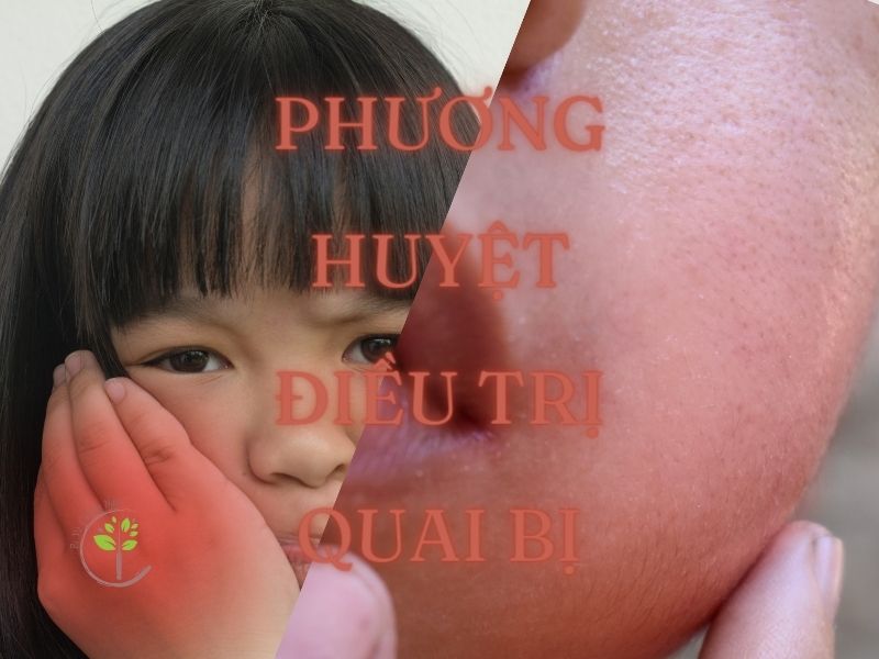 Phương huyệt điều trị bệnh quai bị