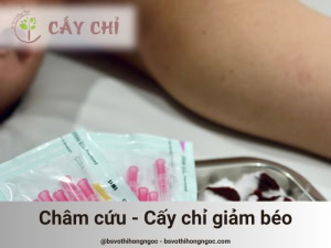 Châm cứu cấy chỉ giảm béo là gì?