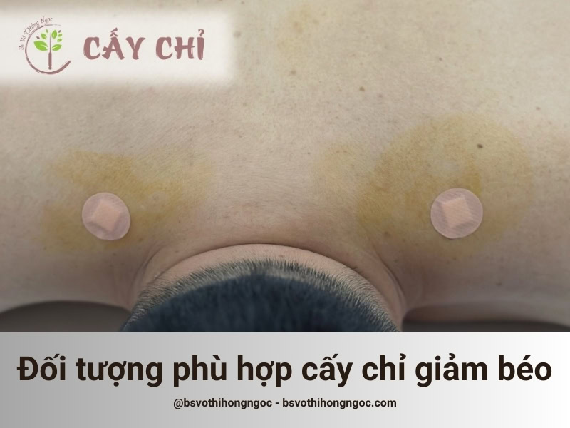 Đối tượng phù hợp với phương pháp cấy chỉ giảm béo